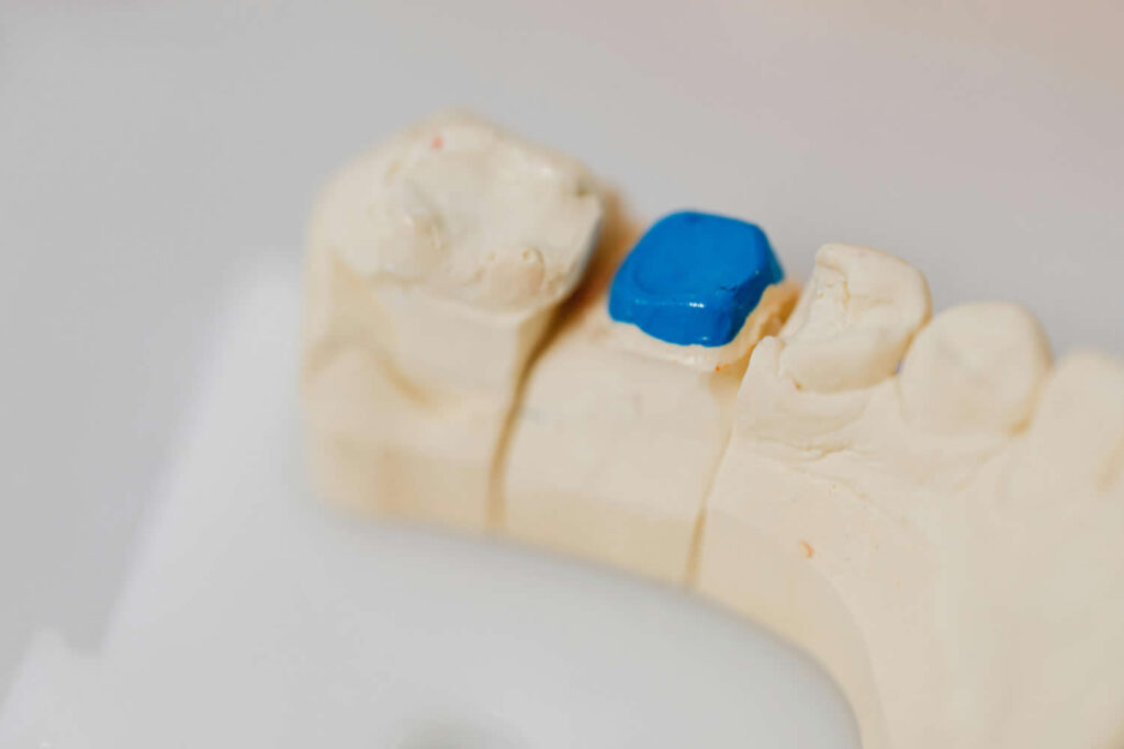 How To Care For Dental Fillings