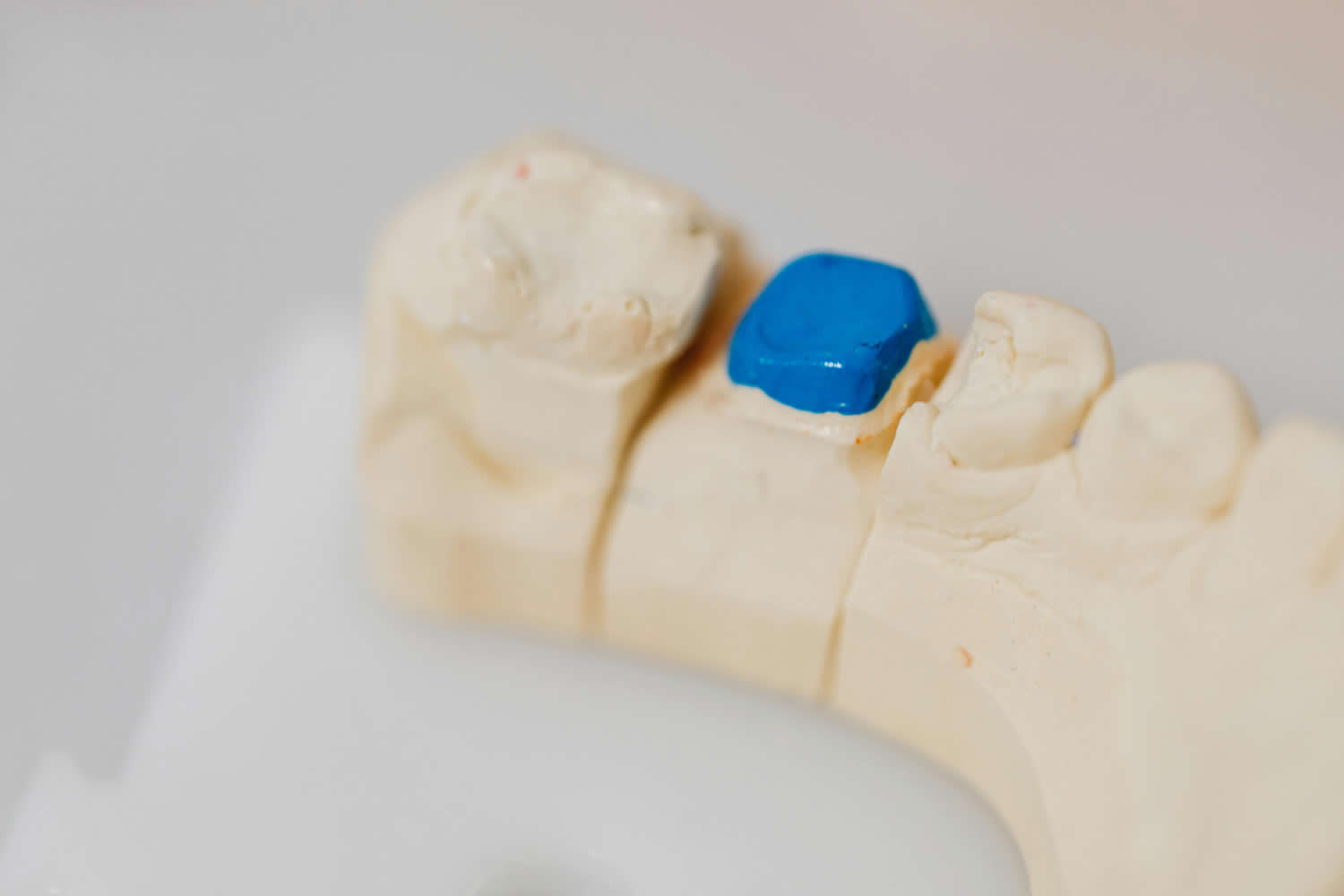 How To Care For Dental Fillings